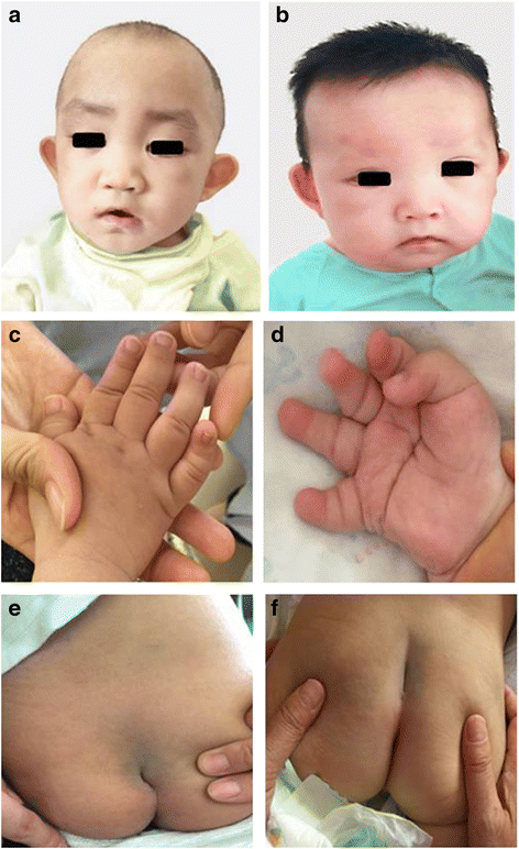 Identification of novel KMT2D mutations in two children with Kabuki syndrome: a report and systematic literature review | BMC Medical Genetics | Full Text