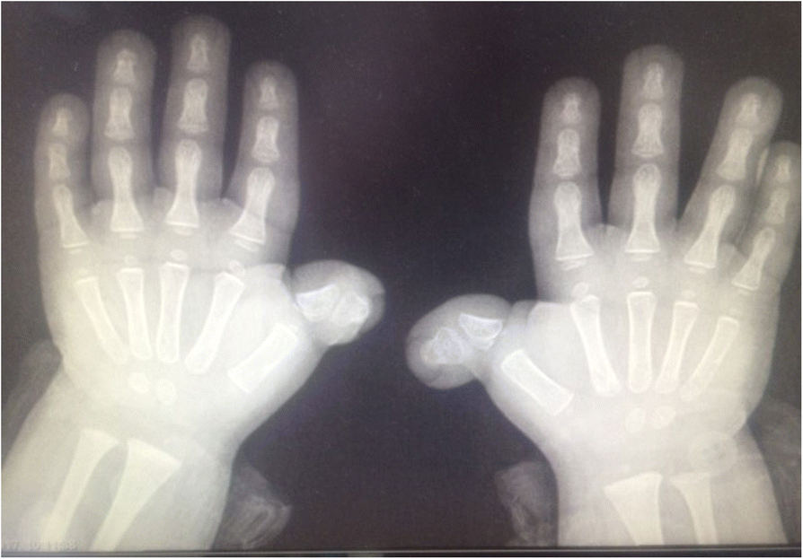 Rubinstein-Taybi syndrome in a Saudi boy with distinct features