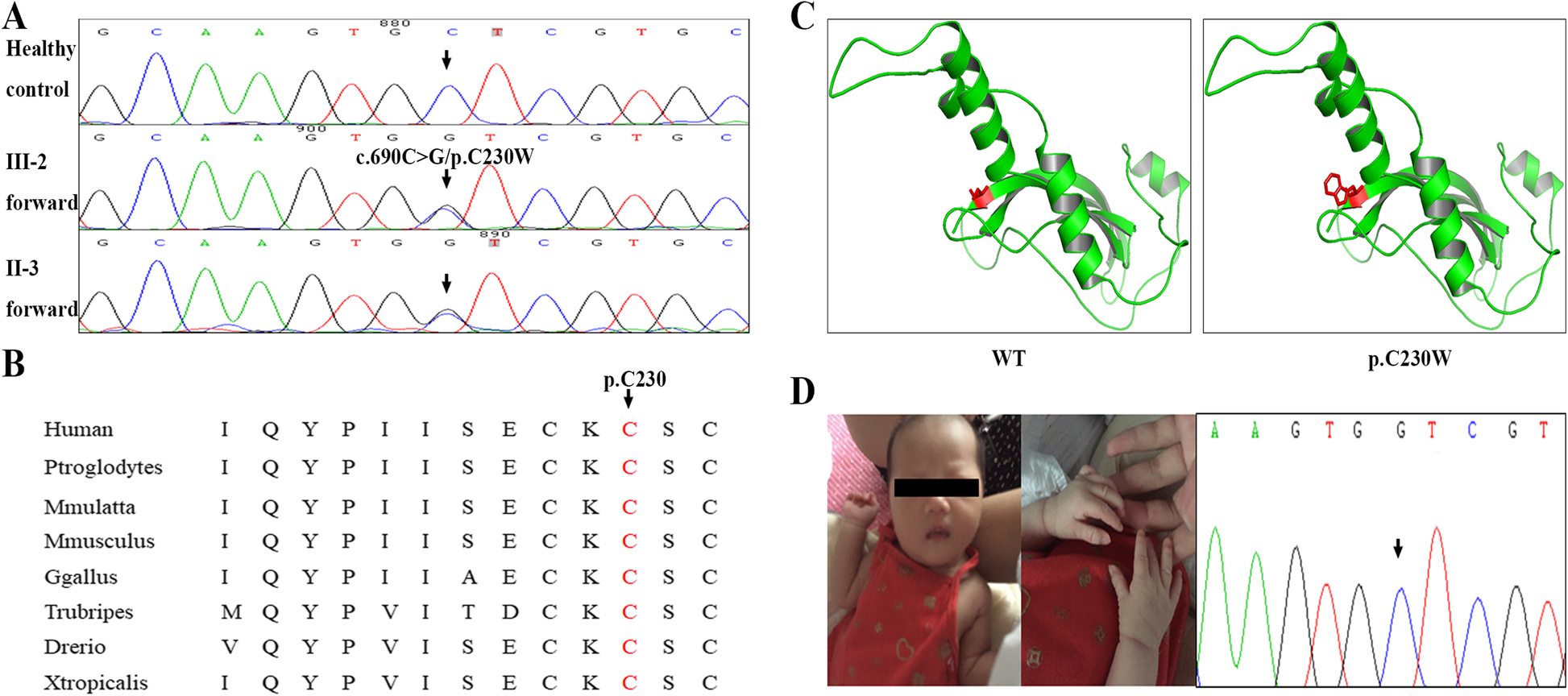 Identification of a novel mutation of NOG in family with proximal  symphalangism and early genetic counseling | BMC Medical Genetics | Full  Text