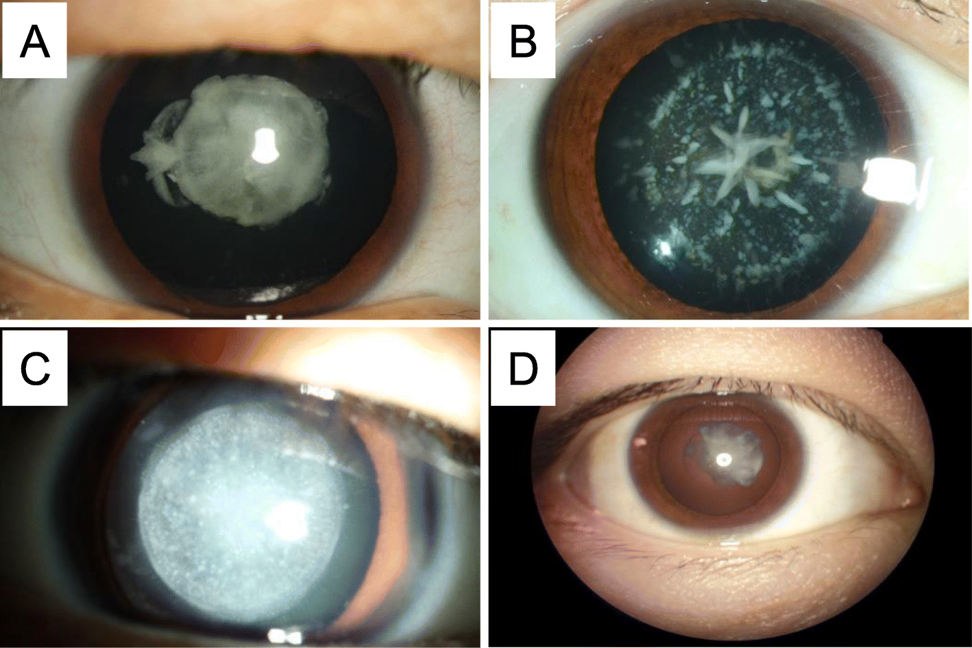congenital cataract