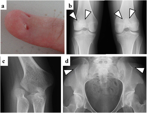 Figure 4 from Nail-Patella Syndrome (A Case Report) | Semantic Scholar