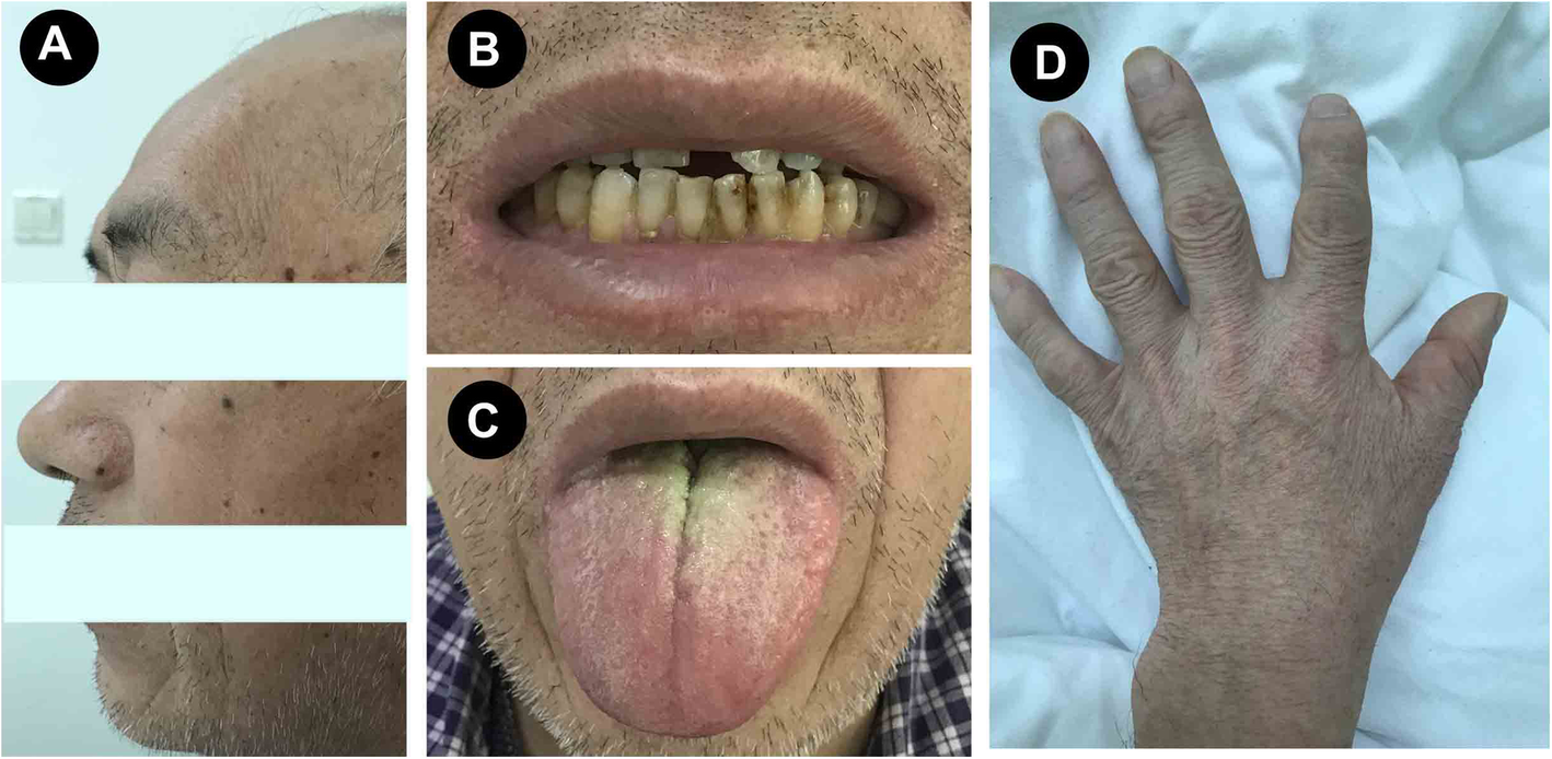 Delayed diagnosis of acromegaly in a patient with focal segmental  Glomerulosclerosis: a rare case report and literature review | BMC  Nephrology | Full Text