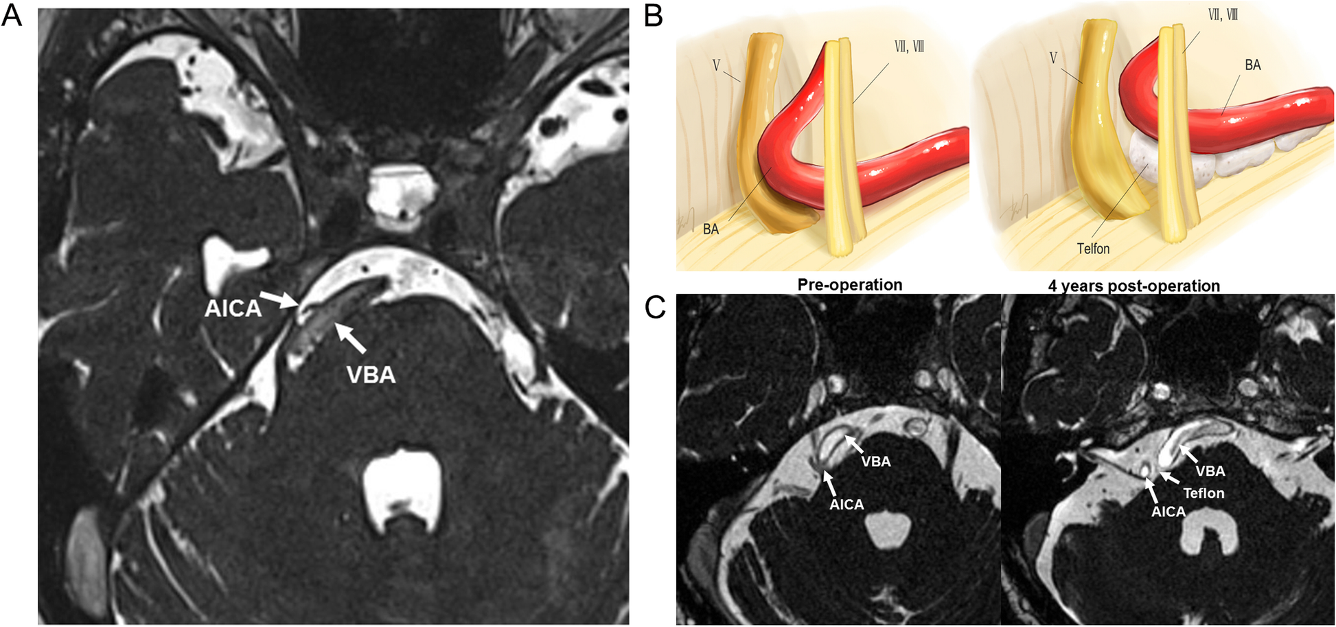 The Long Term Clinical Outcomes Of Microvascular Decompression For Treatment Of Trigeminal Neuralgia Compressed By The Vertebra Basilar Artery A Case Series Review Bmc Neurology Full Text
