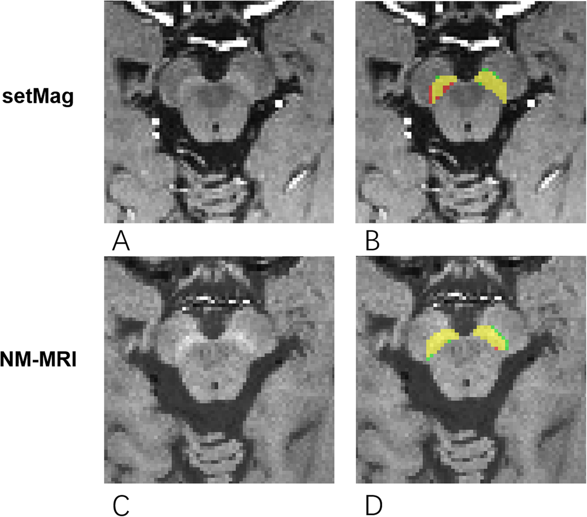 substantia nigra mri