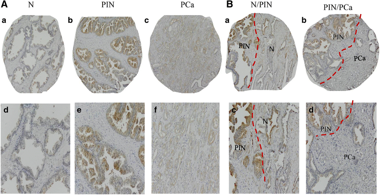 Prostate specific G protein coupled receptor is associated with prostate  cancer prognosis and affects cancer cell proliferation and invasion | BMC  Cancer | Full Text