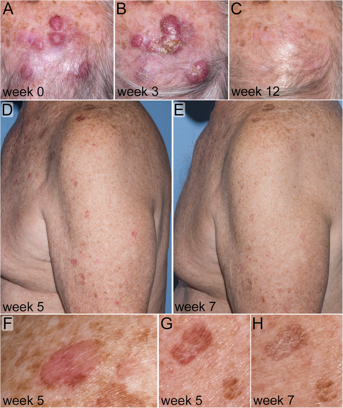 Merkel Cell Carcinoma Treatment