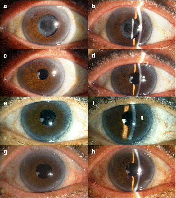 Complete occlusion of anterior capsulorhexis after uneventful cataract  surgery, treated with YAG laser capsulotomy | BMC Ophthalmology | Full Text