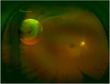 The Application Of Wide Field Laser Ophthalmoscopy In Fundus The Application Of Wide Field Laser Ophthalmoscopy In Fundus