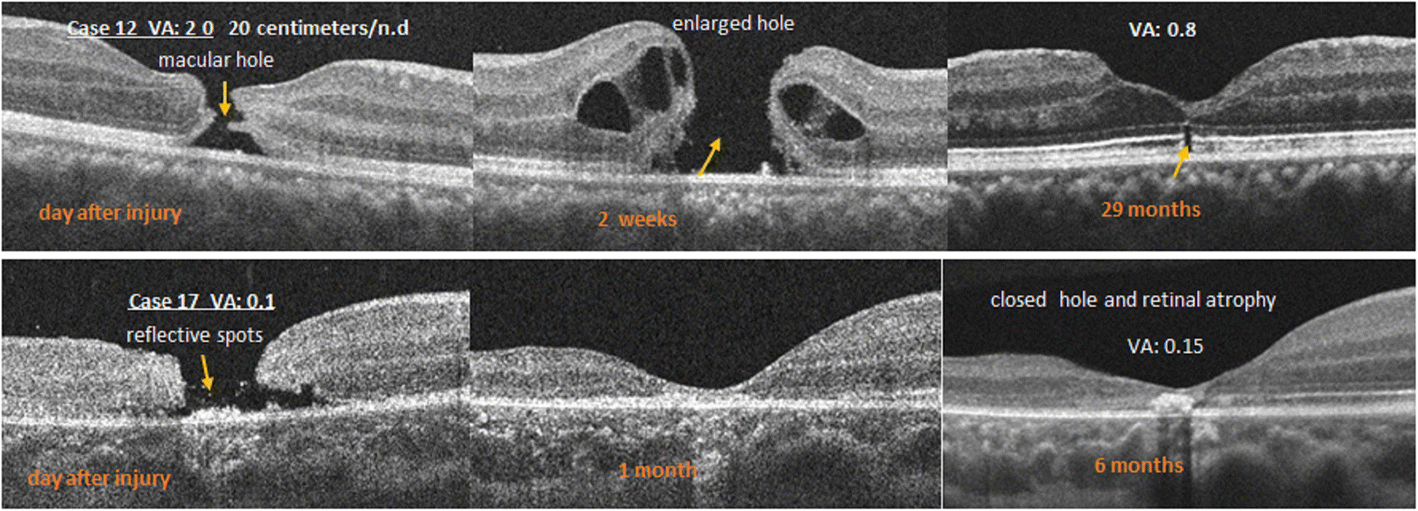 Optical Coherence Tomography Patterns And Outcomes Of Contusion Optical Coherence Tomography Patterns And Outcomes Of Contusion