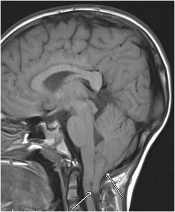 Chiari malformation symptoms