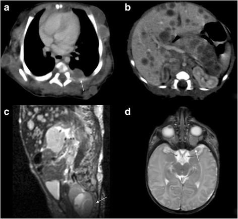 Congenital Rhabdomyosarcoma: a different clinical presentation in two