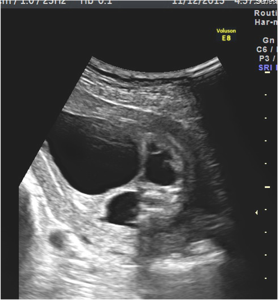 Prenatal diagnosis of congenital megalourethra with imperforate anus