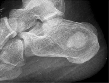 Cementoma of the calcaneus: a case report | BMC Musculoskeletal
