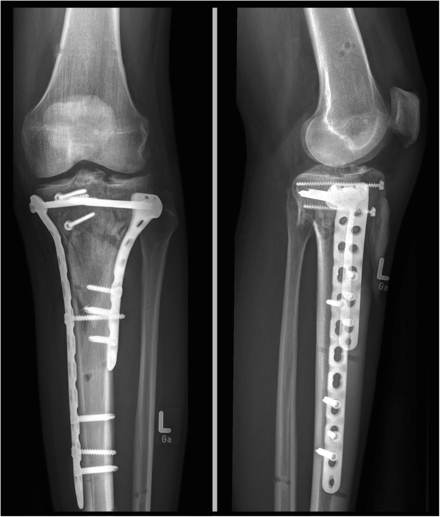 Duration of incapacity of work after tibial plateau fracture is affected by...