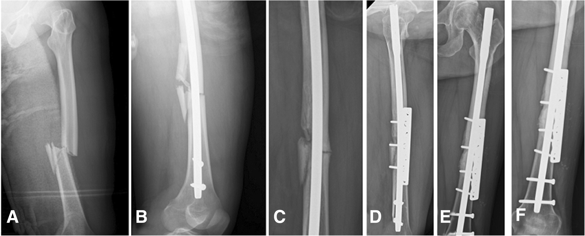 Humeral intramedullary nail bending following trauma: a case report