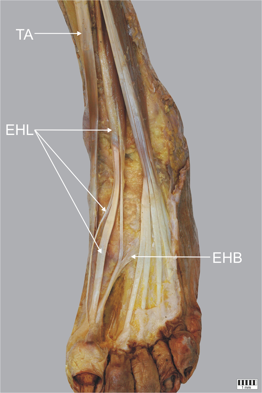 A Cadaveric Study Of The Morphology Of The Extensor Hallucis Longus A Proposal For A New Classification Bmc Musculoskeletal Disorders Full Text