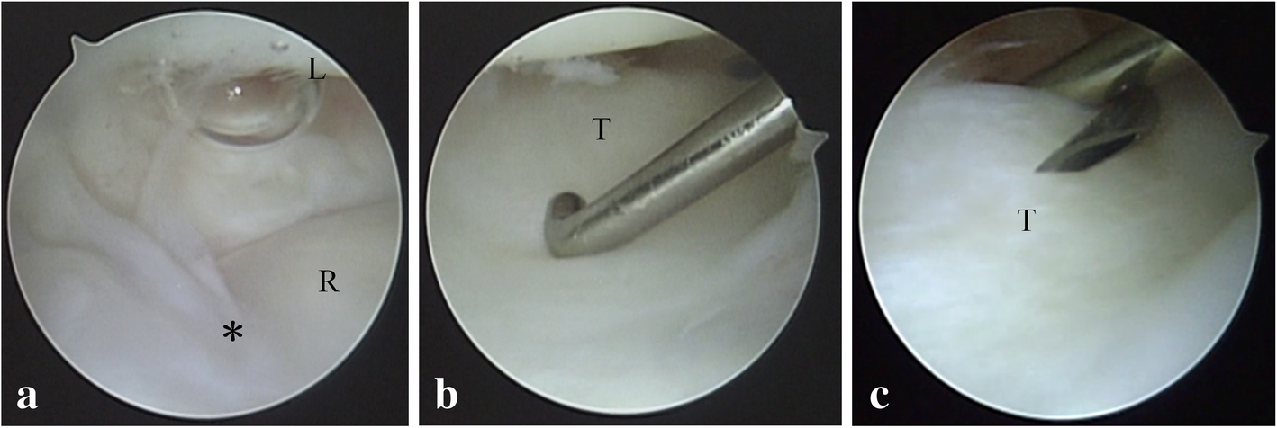 Ferie Intrusion Løfte Arthroscopic reduction of an irreducible distal radioulnar joint in  Galeazzi fracture-dislocation due to a fragment of the ulnar styloid: a  case report | BMC Musculoskeletal Disorders | Full Text