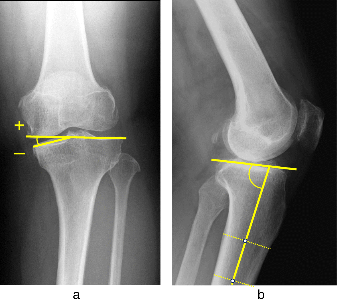 Comparison Of Radiological Features Of High Tibial Osteotomy