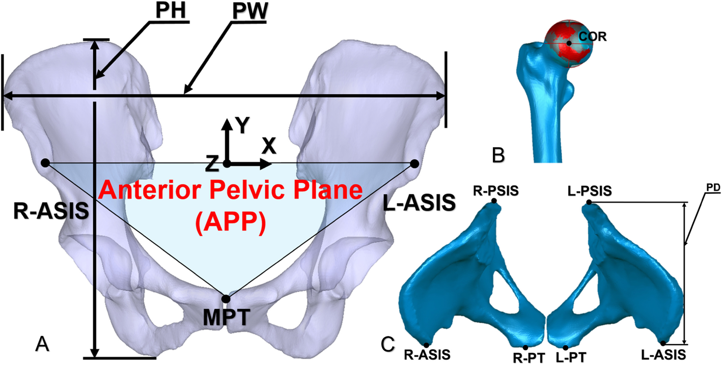 Relations between the Crowe classification and the 3D femoral head  displacement in patients with developmental dysplasia of the hip | BMC  Musculoskeletal Disorders | Full Text