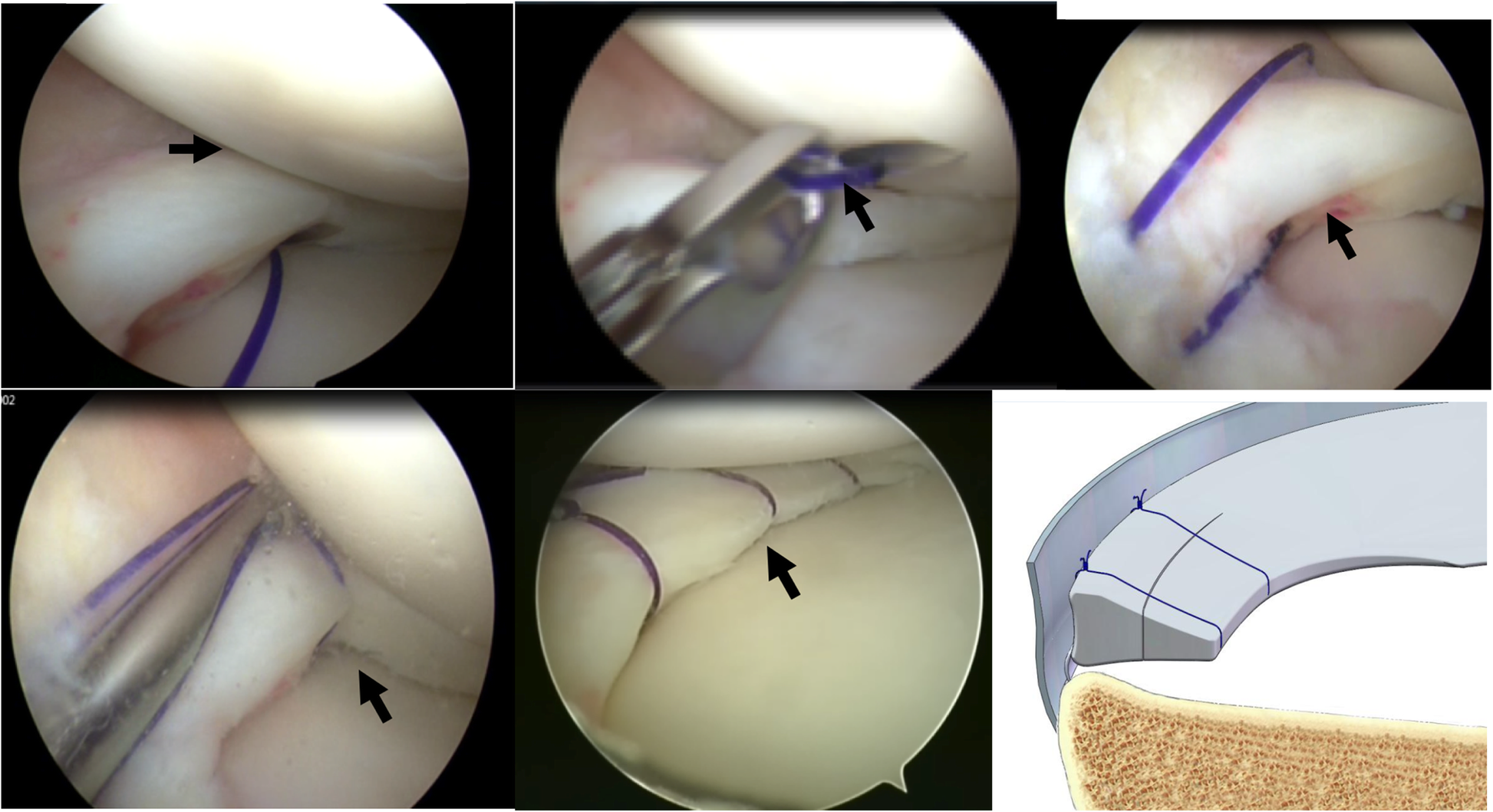 An arthroscopic repair technique for meniscal tear using a needle and  suture: outside-in transfer all-inside repair | BMC Musculoskeletal  Disorders | Full Text