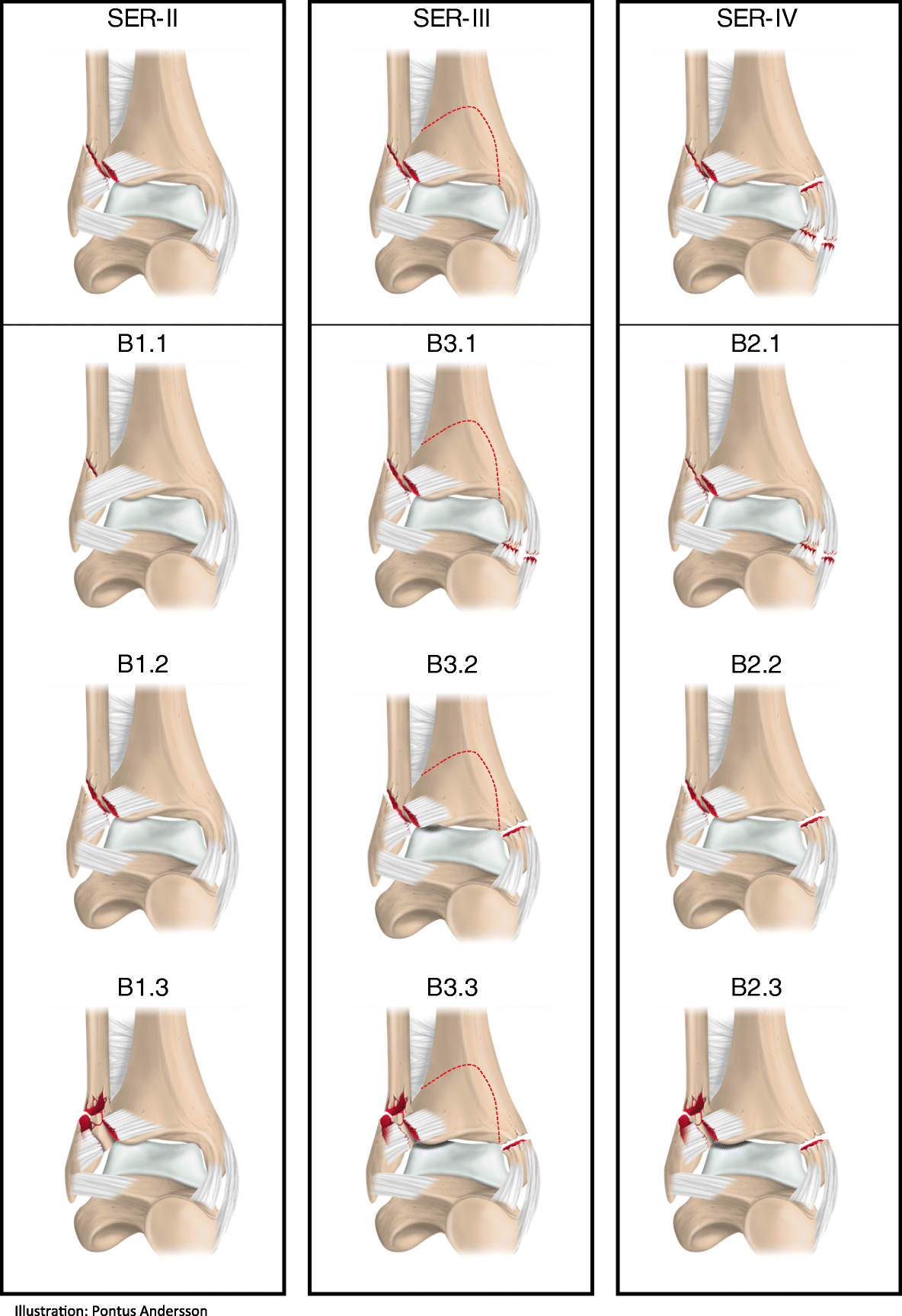 Classification and treatment of lateral malleolar fractures - a  single-center analysis of 439 ankle fractures using the Swedish Fracture  Register | BMC Musculoskeletal Disorders | Full Text