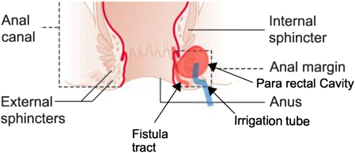 Canine perianal fistula medical approach