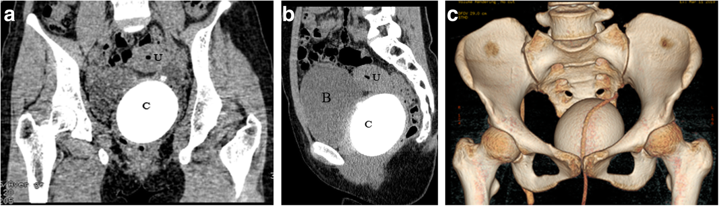 Primary vaginal calculus in a woman with urogenital sinus anomaly: a case  report | BMC Urology | Full Text