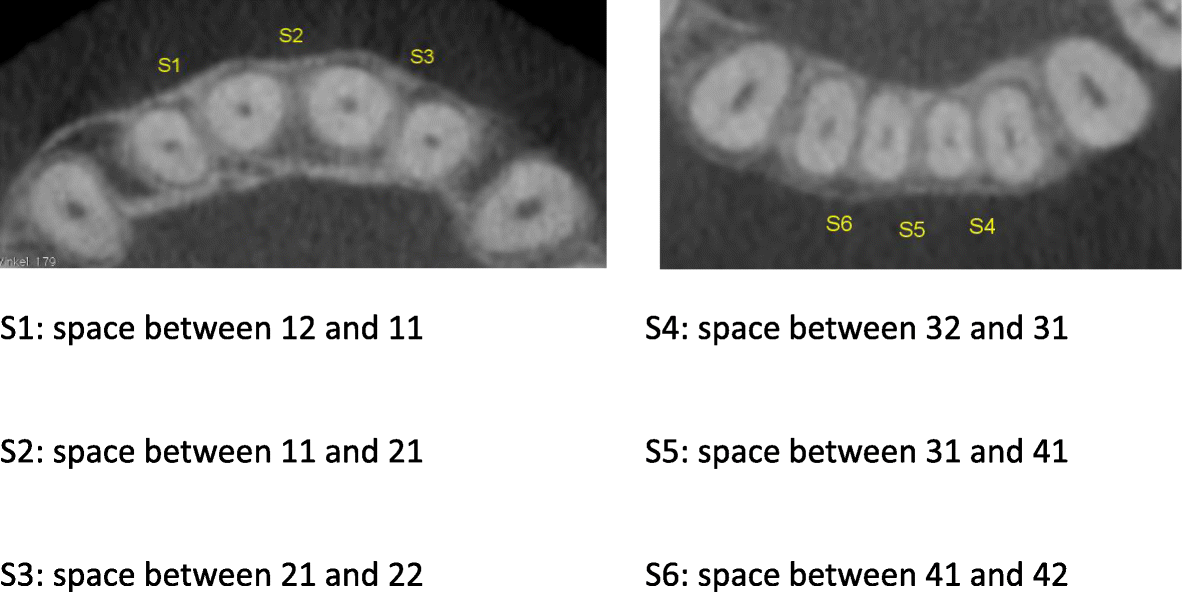 influence on interradicular bone volume of invisalign interradicular bone