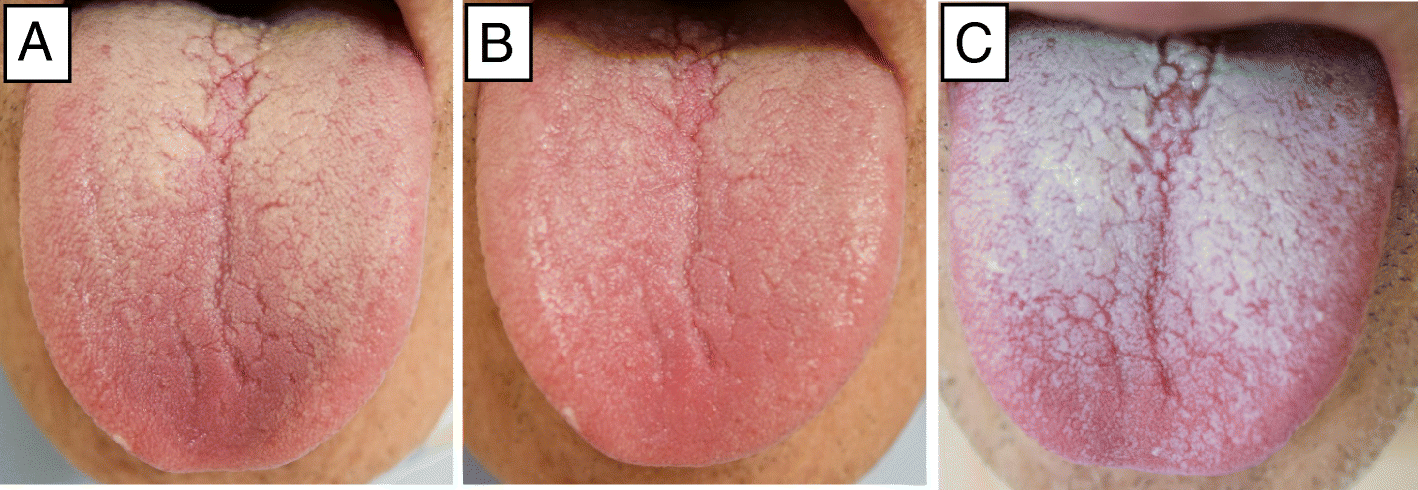 normal tongue coating