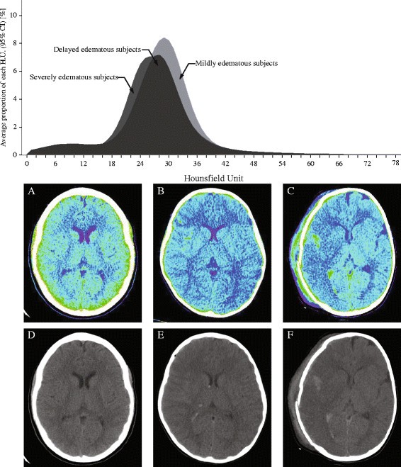 quantitative analysis of computed tomography images and early cerebral edema