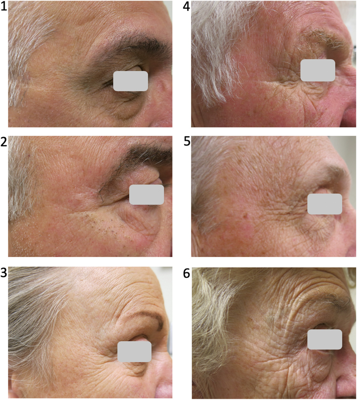 Loss of skin elasticity is associated with pulmonary emphysema, biomarkers  of inflammation, and matrix metalloproteinase activity in smokers |  Respiratory Research | Full Text