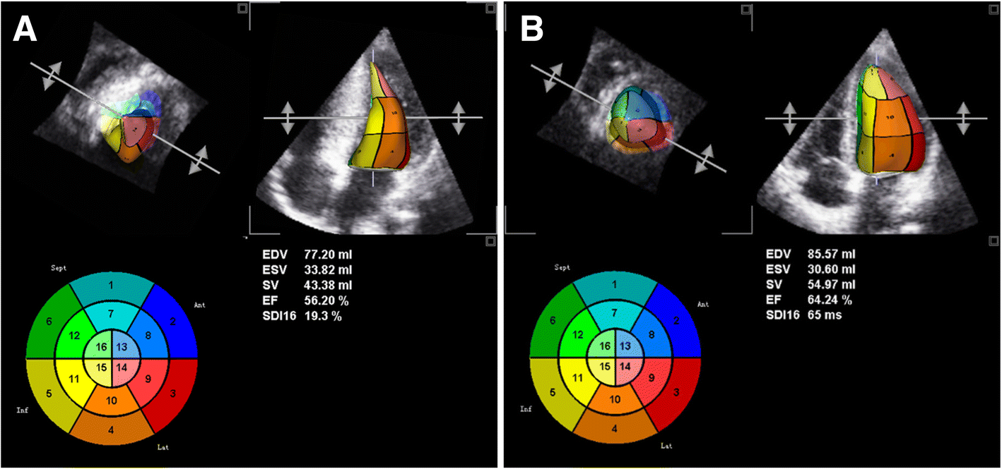 Echocardiographic Assessment of Left Ventricular Systolic Function: An  Overview of Contemporary Techniques, Including Speckle‐Tracking  Echocardiography