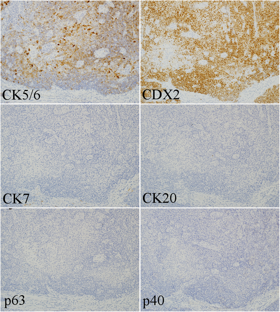 The Origin Of P40 Negative And Cdx2 Positive Primary Squamous Cell Carcinoma Of The Stomach Case Report World Journal Of Surgical Oncology Full Text