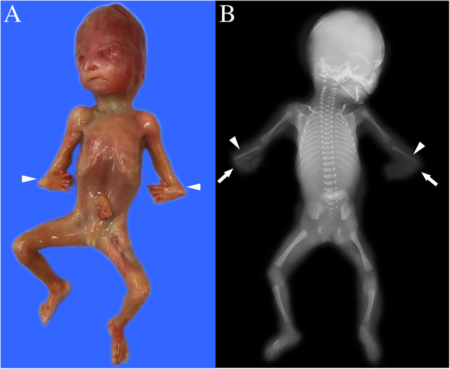 Prenatal diagnosis of fetal skeletal dysplasia using targeted  next-generation sequencing: an analysis of 30 cases | Diagnostic Pathology  | Full Text