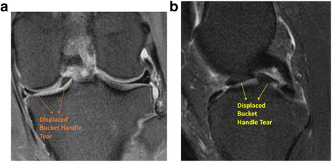 A novel technique for modified all-inside repair of bucket-handle meniscus  tears using standard arthroscopic portals | Journal of Orthopaedic Surgery  and Research | Full Text
