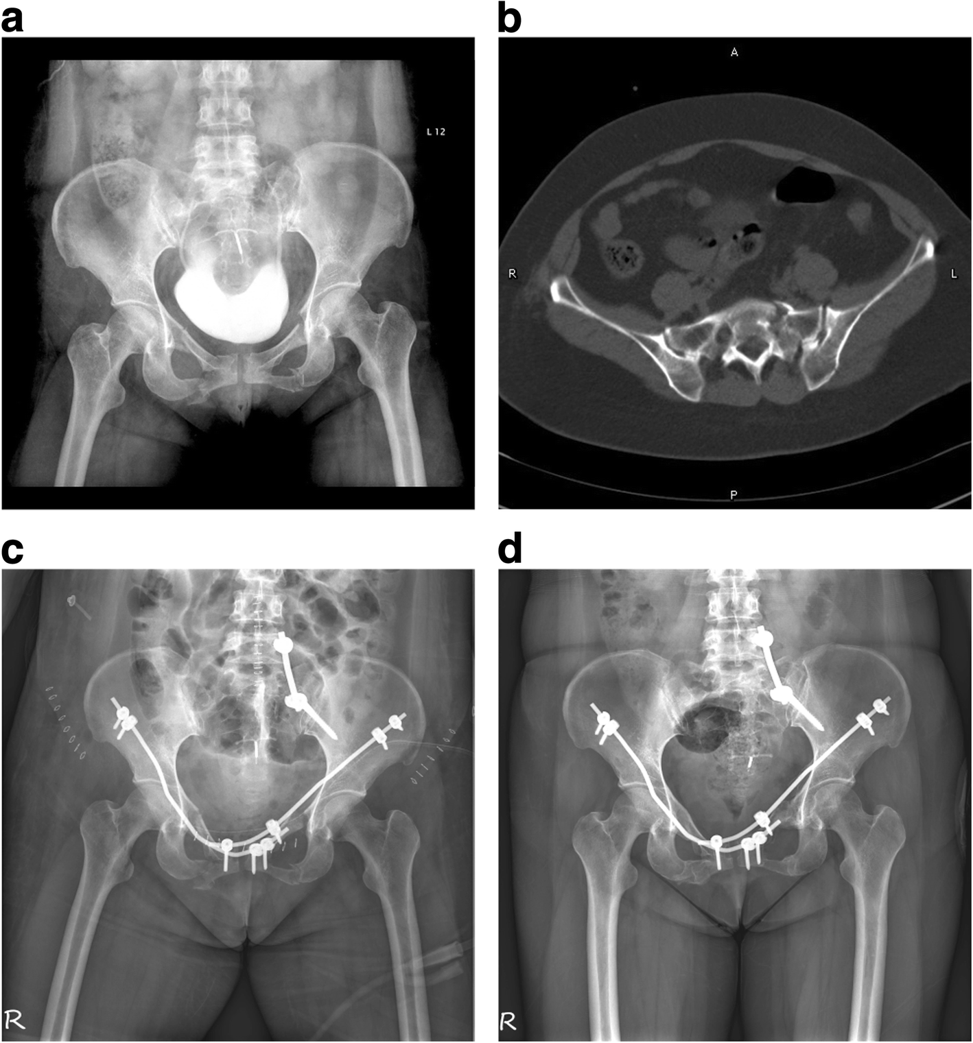 Minimally invasive treatment for anterior pelvic ring injuries with  modified pedicle screw-rod fixation: a retrospective study | Journal of  Orthopaedic Surgery and Research | Full Text