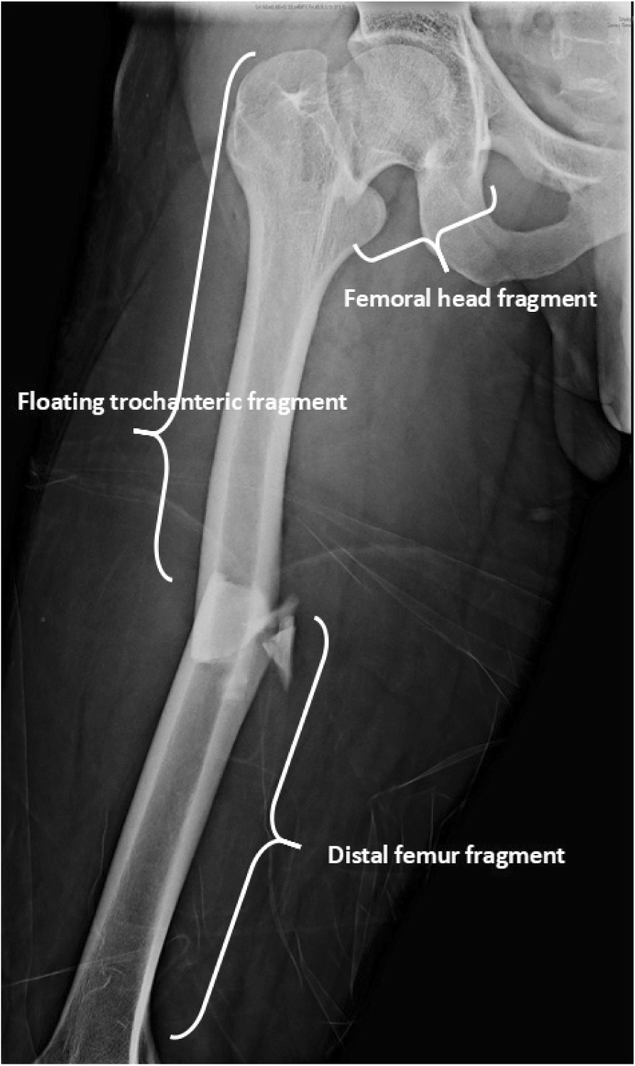 New Intermediate Nail and RC Lag Screw Expand Gamma4 Portfolio to Meet the  Needs of Surgeons and Their Patients