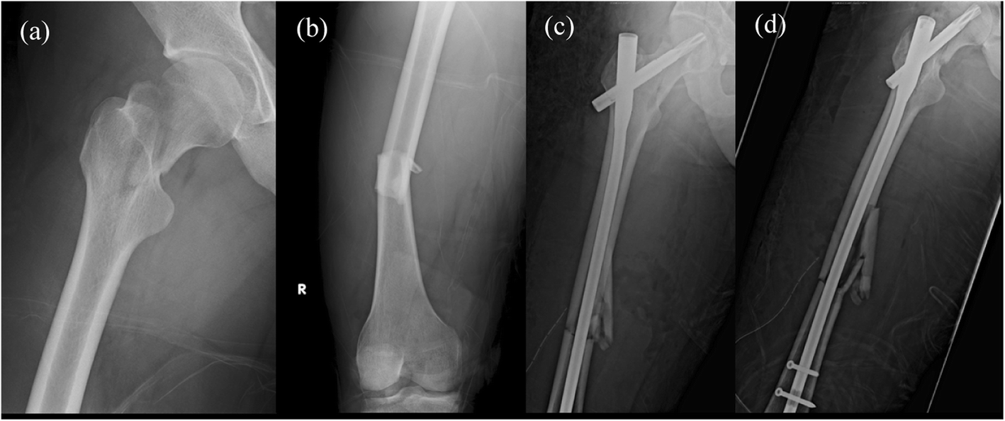Ipsilateral Femoral Neck And Shaft Fractures Fixation With Proximal Femoral Nail Antirotation Ii Pfna Ii Technical Note And Cases Series Journal Of Orthopaedic Surgery And Research Full Text
