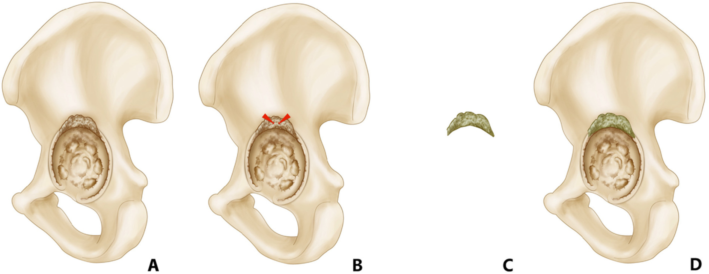 The Use Of Augmented Antibiotic Loaded Cement Spacer In Periprosthetic Joint Infection Patients With Acetabular Bone Defect Journal Of Orthopaedic Surgery And Research Full Text