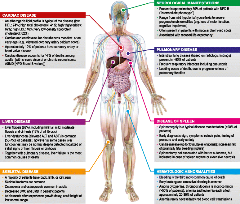 Acid Sphingomyelinase Deficiency - Symptoms, Causes, Treatment