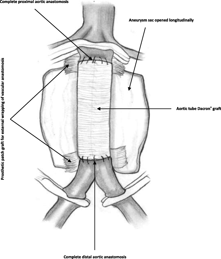 Vascular suture line wrapping for Aortoiliac anastomoses following