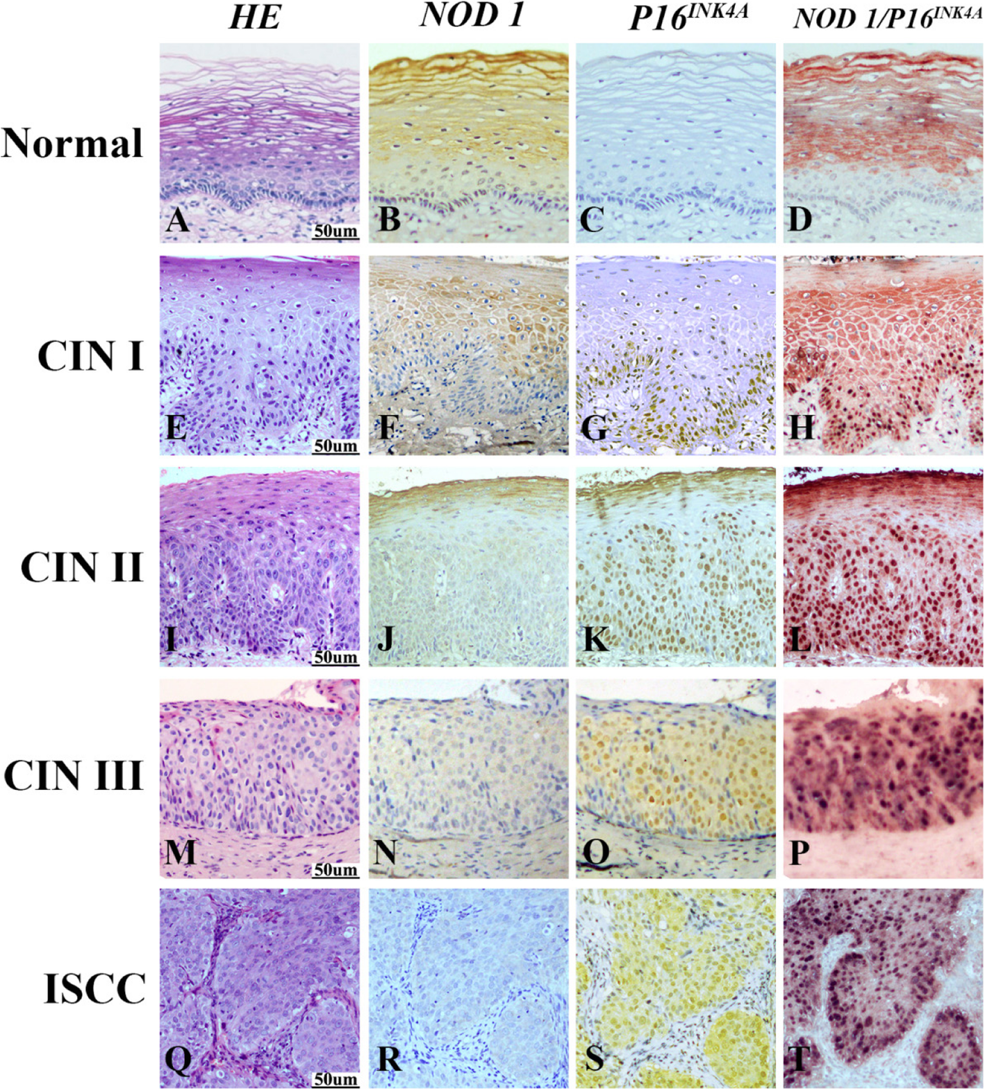 HPV-mediated down-regulation of NOD1 inhibits apoptosis in cervical cancer  | Infectious Agents and Cancer | Full Text