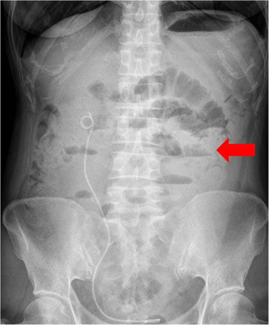 ovarian cancer on x ray