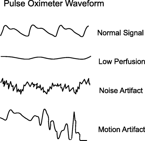 Pulse Oximetry Critical Care Full Text