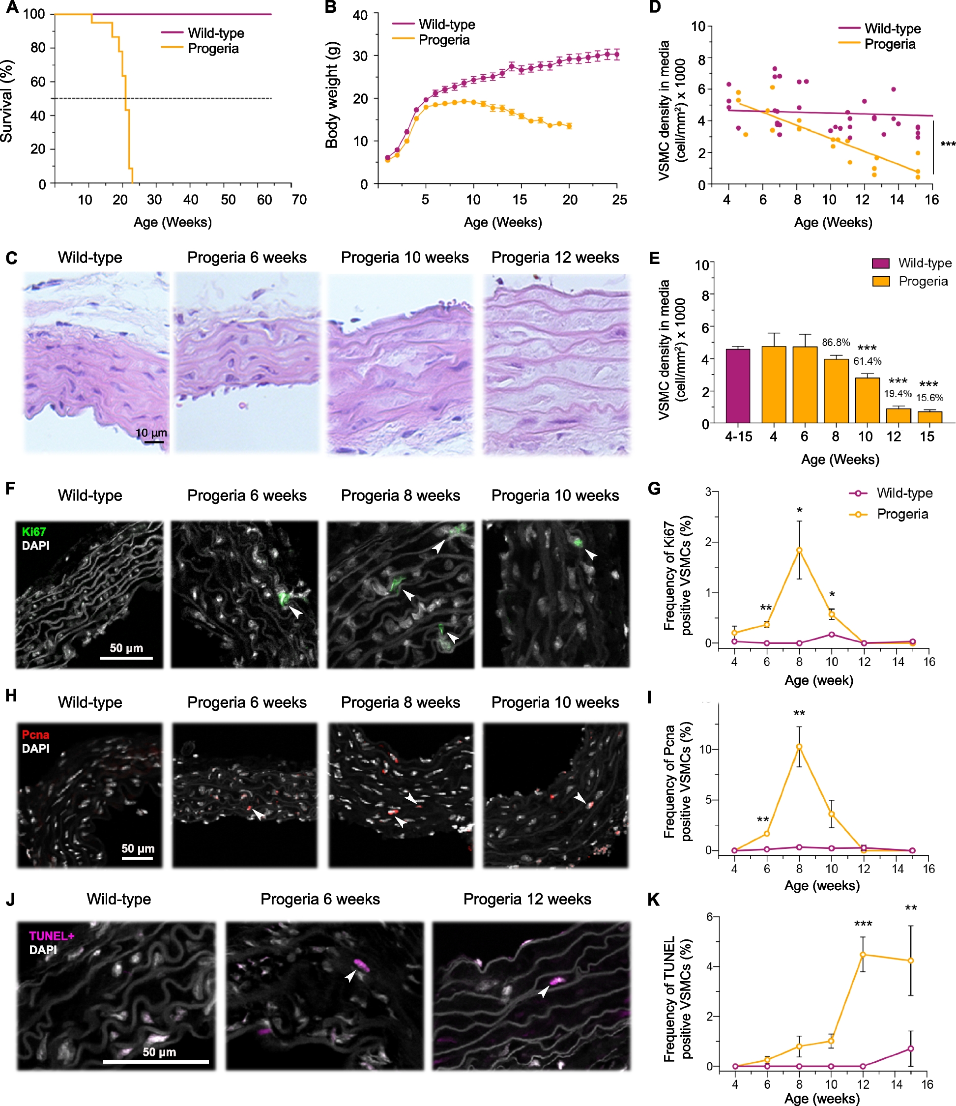 早老症における血管障害と体細胞変異の関連を解明（Somatic Mutations Linked to Vascular Damage in Progeria）
