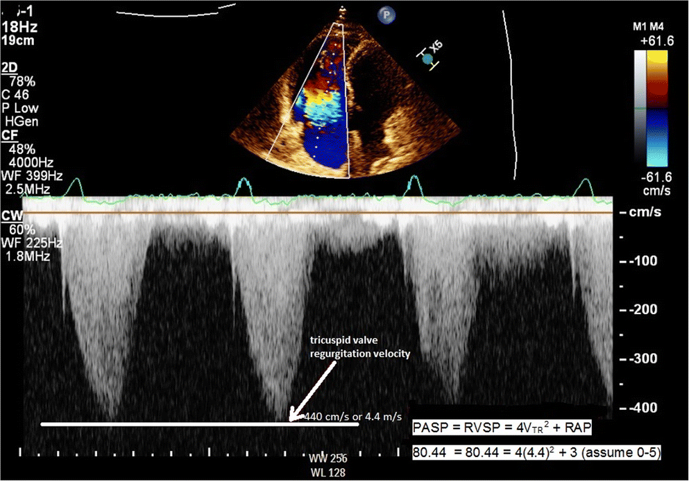 Pathophysiology of right ventricular failure in acute pulmonary embolism  and chronic thromboembolic pulmonary hypertension: a pictorial essay for  the interventional radiologist | Insights into Imaging | Full Text