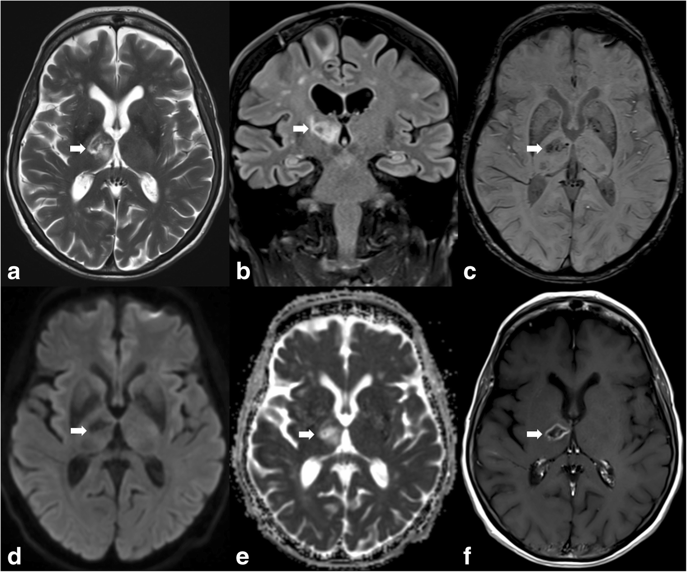Гиперинтенсивный т2. Гиперинтенсивный сигнал на мрт. Мрт т1 и т2 режимы что это. Т2 ви и flair. Т2 ви и flair.