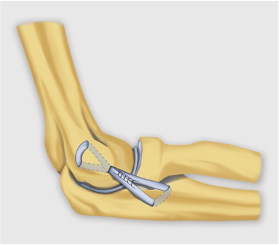 The elbow: review of and common collateral ligament complex pathology using MRI | Insights Imaging | Full