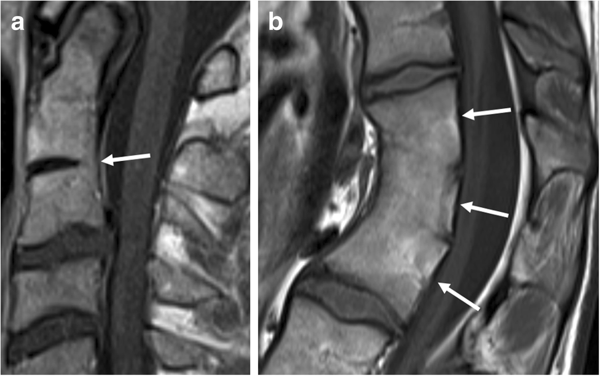 MRI of the axial skeleton in spondyloarthritis: the many faces of new bone  formation | Insights into Imaging | Full Text