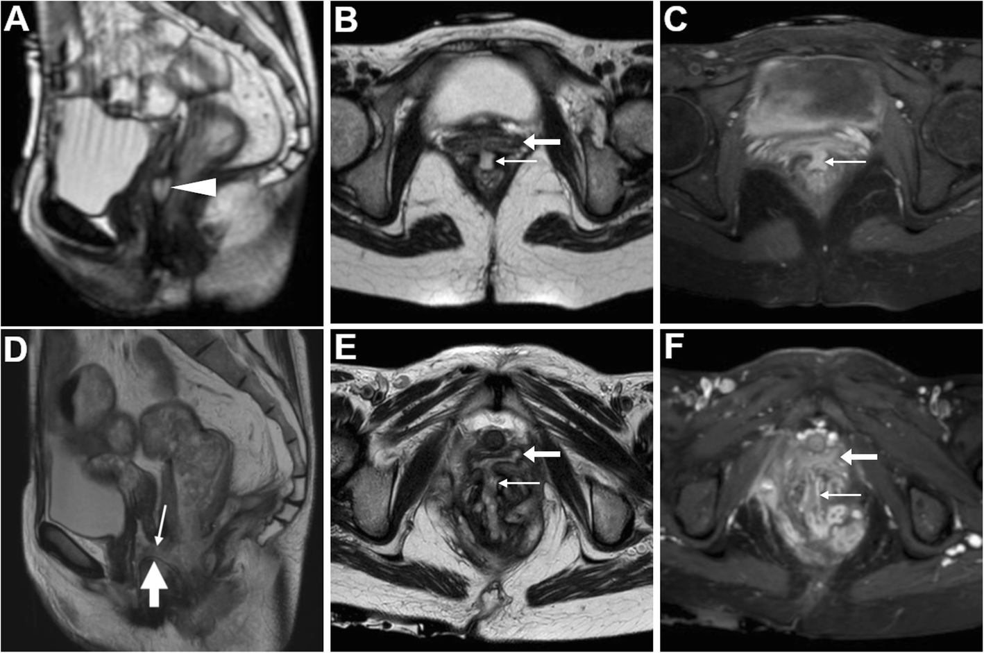 Elucidating vaginal fistulas on CT and MRI | Insights into Imaging | Full  Text